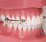 palatal expander