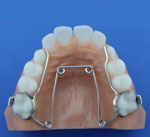 palatal expander